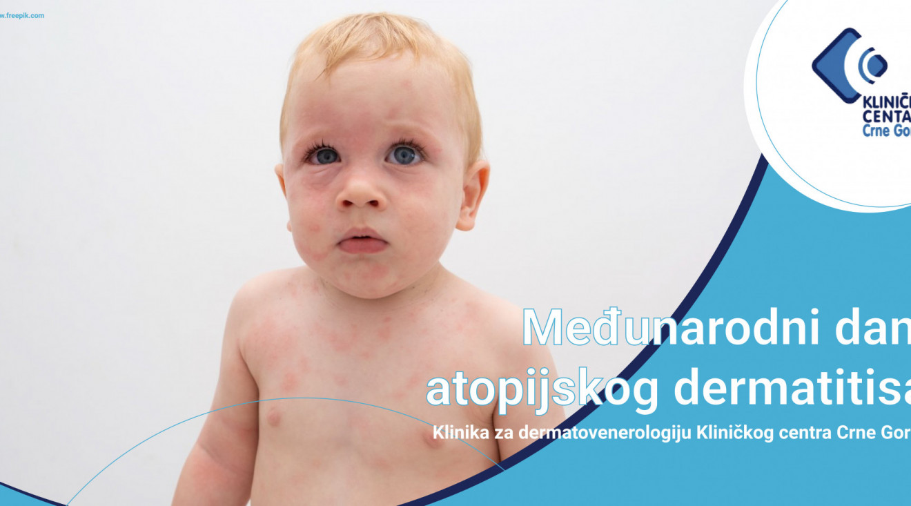 Preventivni pregledi atopijskog dermatitisa bez uputa i zakazivanja 14. i 15. septembra u Kliničkom centru