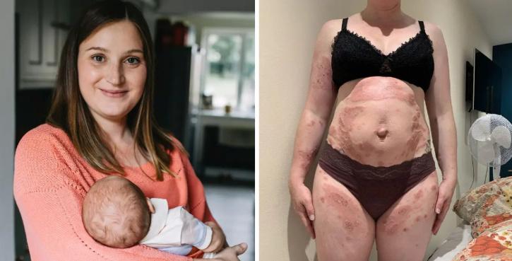 Mama alergična na rođenu bebu