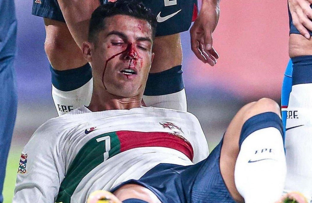 Igrajući za reprezentaciju Portugala: Ronaldo dobio žestok udarac u nos protiv Češke