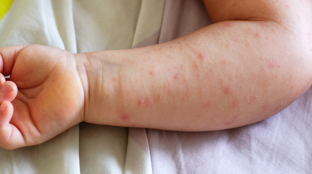 Opasnost od epidemije malih boginja