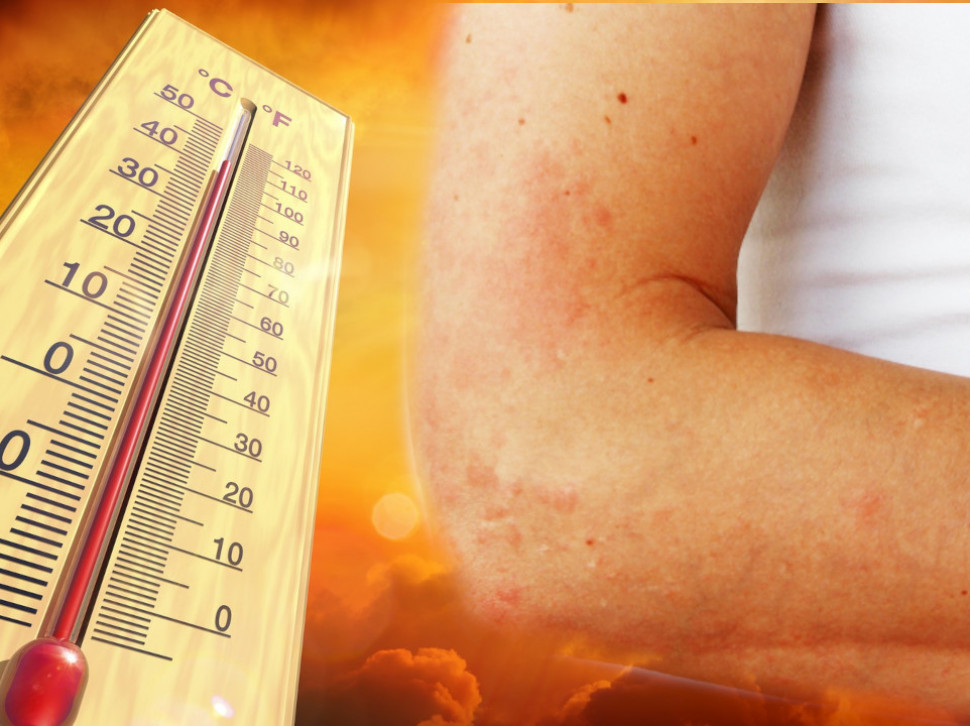 Koji su simptomi i kako liječiti alergiju na sunce?