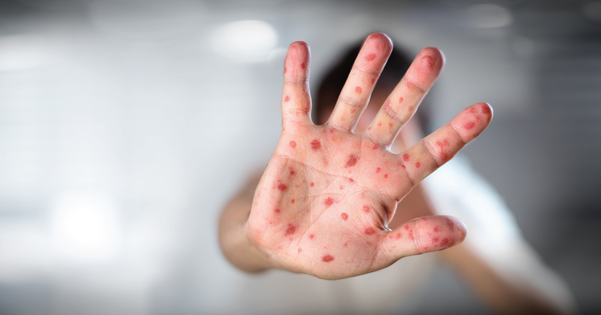 Epidemija morbila prijavljena u Rožajama, raste rizik od naglog širenja malih boginja