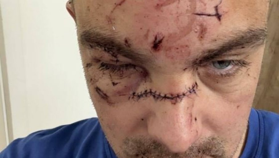 Tužilaštvo o tuči košarkaša Partizana: To su teške tjelesne povrede, slijedi saslušanje osumnjičenog