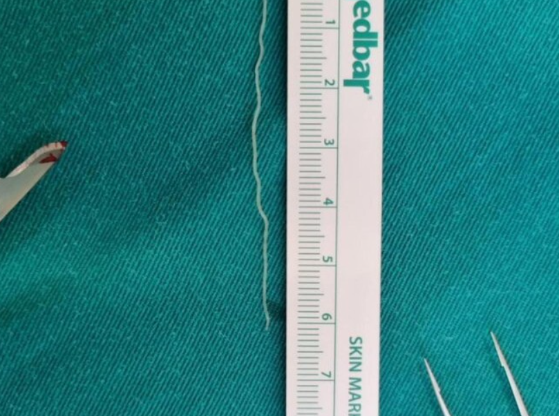 Banjalučki doktor objavio fotografiju: Iz kapka odstranjen crv od šest centimetara