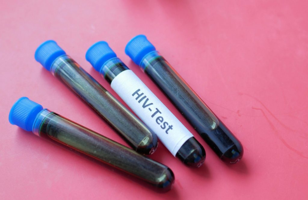 Njemački naučnici pronašli antitijelo protiv HIV-a?