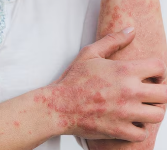 Sve što treba da znate o psorijazi: Šta su glavni ‘okidači’, kako da je prepoznate i kako se leči