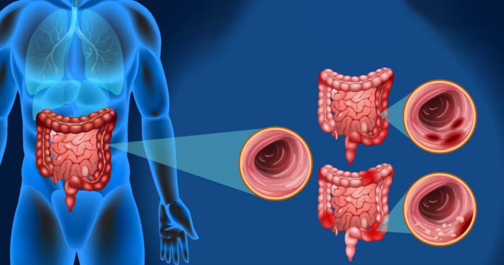 Gastroenterolog upozorava: Ovih pet simptoma mogu ukazivati na ozbiljne probleme sa crijevima