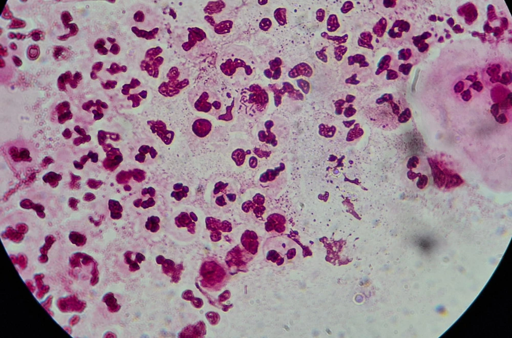 Opasna infekcija širi se Evropom: Polna bolest sve otpornija na antibiotike