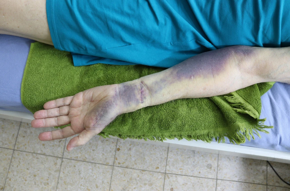 Vrućine povećavaju rizik od tromboze: Doktor otkriva ko je najugroženiji i kako da se zaštitite